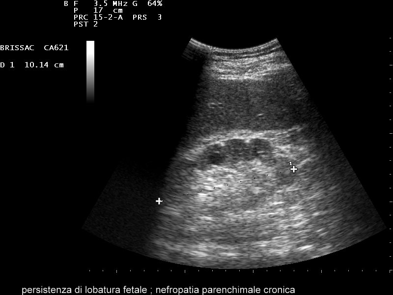 La Refertazione In Ecografia Nefrologica Nephromeet